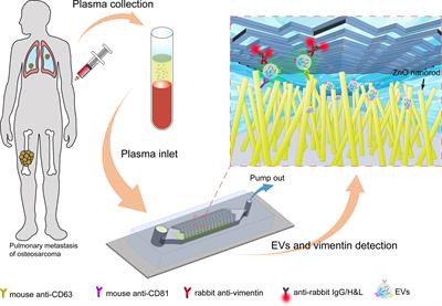 A Novel Microfluidic Chip for Fast, Sensitive Quantification of Plasma Extracellular Vesicles as Biomarkers in Patients With Osteosarcoma